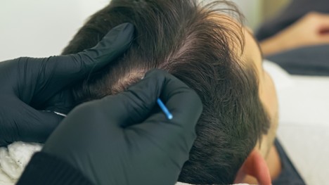 Mikropigmentácia pokožky hlavy: Dokáže zvrátiť vypadávanie vlasov a ich rednutie?!