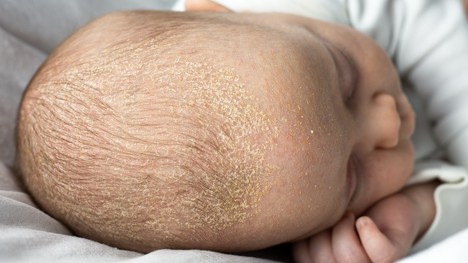 Mliečna chrasta u dojčiat – ako ju rozpoznať a správne liečiť?