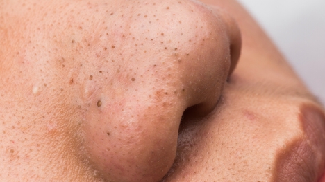 Slávna lekárka Pimple Popper radí: Ako odstrániť čierne bodky?