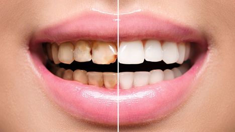 Zastavený zubný kaz nie je mýtus! Ako ho zastaviť?