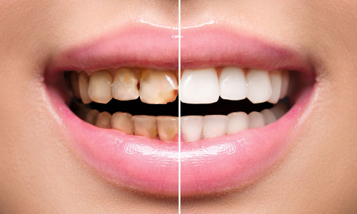 Zastavený zubný kaz nie je mýtus! Ako ho zastaviť?