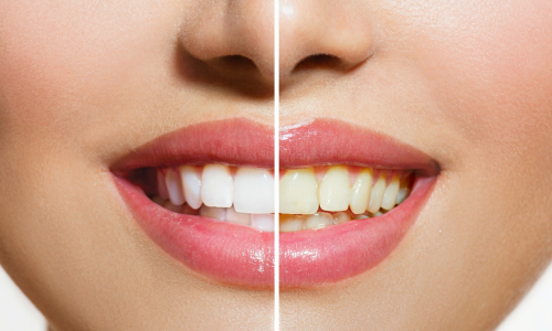Biele zuby na dosah: Vyskúšaj jednoduché triky pre krajší úsmev