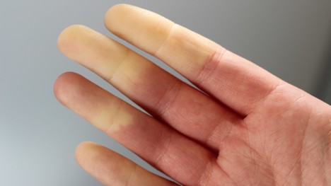 Raynaudov syndróm: Ako sa prejavuje fenomén studených nôh a rúk?