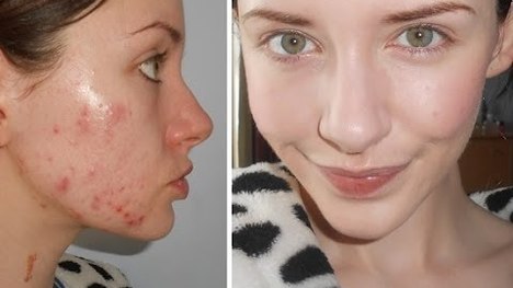 Každodenná rutina s make-upom pri akné