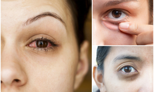 Problémy s očami: Čo znamenajú suché oči alebo zažltnuté bielka?