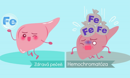 Vieš, čo je hemochromatóza? Následky ochorenia môžu byť trpké!