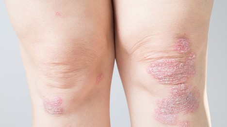 Psoriatická artritída – keď sa ku kĺbom pridá aj problém s kožou