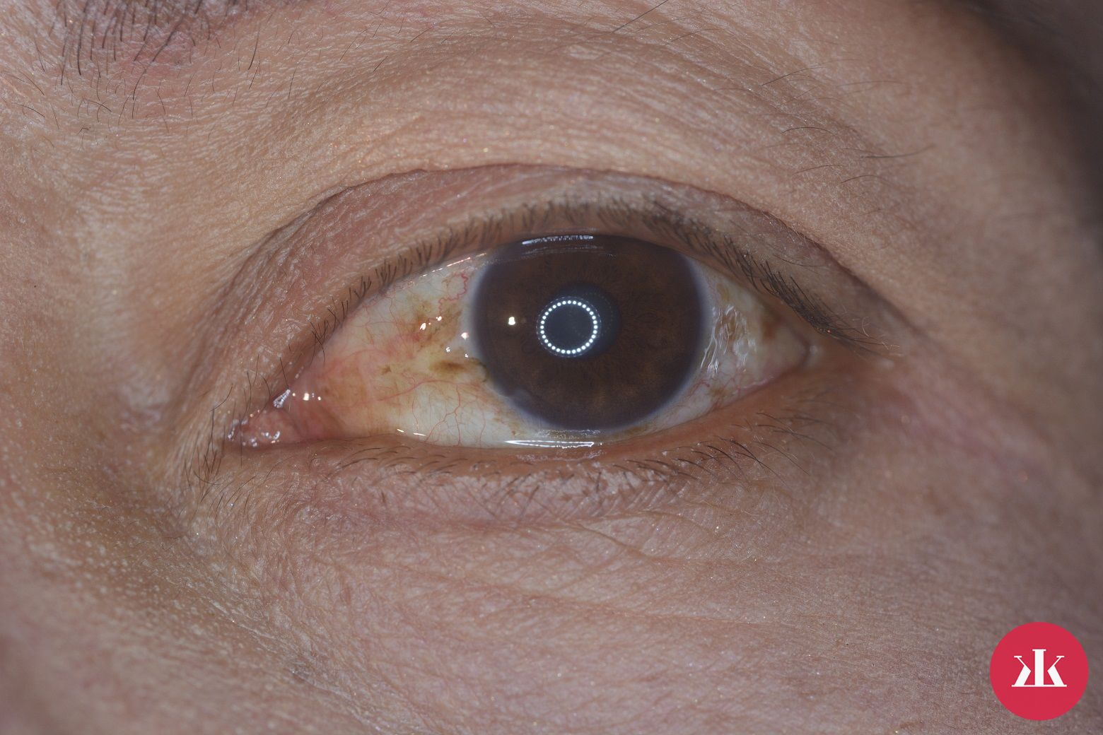 porucha očnej rohovky