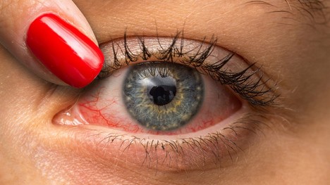 Zápal očnej dúhovky – pri ktorých príznakoch neodkladať vyšetrenie u očného lekára?