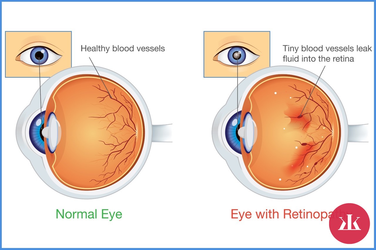 príznaky retinopatie