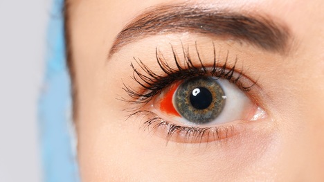 Prasknuté žilky v oku: Čo všetko môže byť ich príčinou?