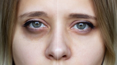 5 tipov, ako minimalizovať tmavé kruhy pod očami: Nesiahaj len po uhorke!