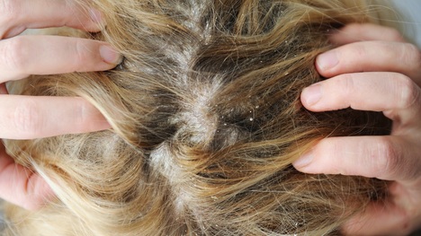 Ochorenia vlasovej pokožky: Takto si s nimi hravo poradíš!