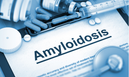 Čo je amyloidóza? Zisti o tomto zákernom ochorení všetko dôležité!