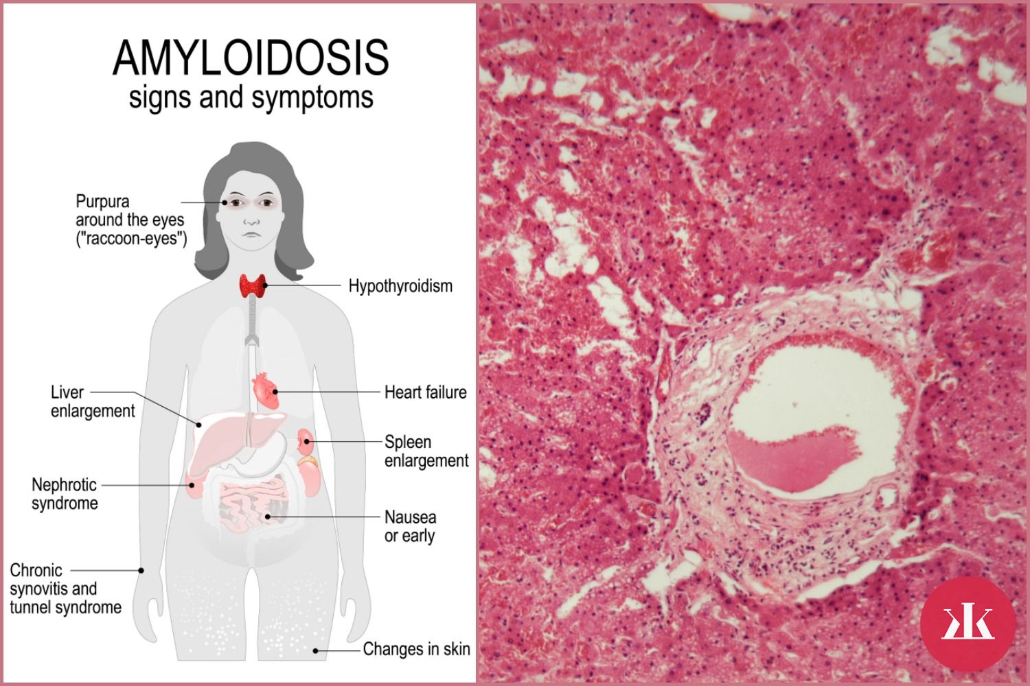 prejavy amyloidózy