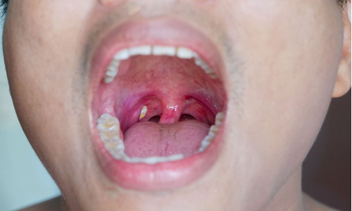 Mandľové kamene: Príčina zápachu z úst, o ktorej vie len málokto!