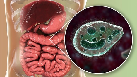 Balantidióza: Ako sa prejavuje táto črevná infekcia a čo ju spôsobuje?
