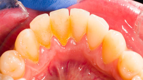 Zubný plak ako príčina dvoch najčastejších ochorení ústnej dutiny