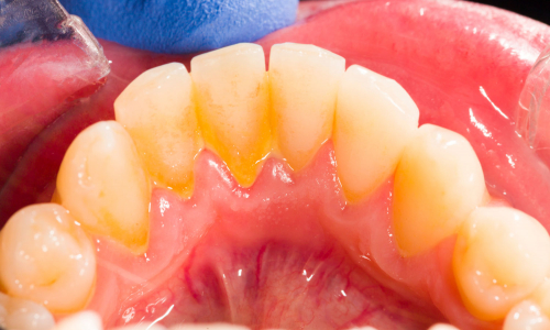 Zubný plak ako príčina dvoch najčastejších ochorení ústnej dutiny