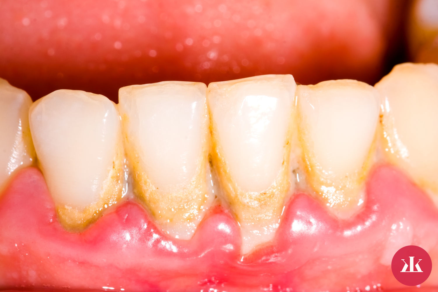 vznik a pricina zubneho plaku