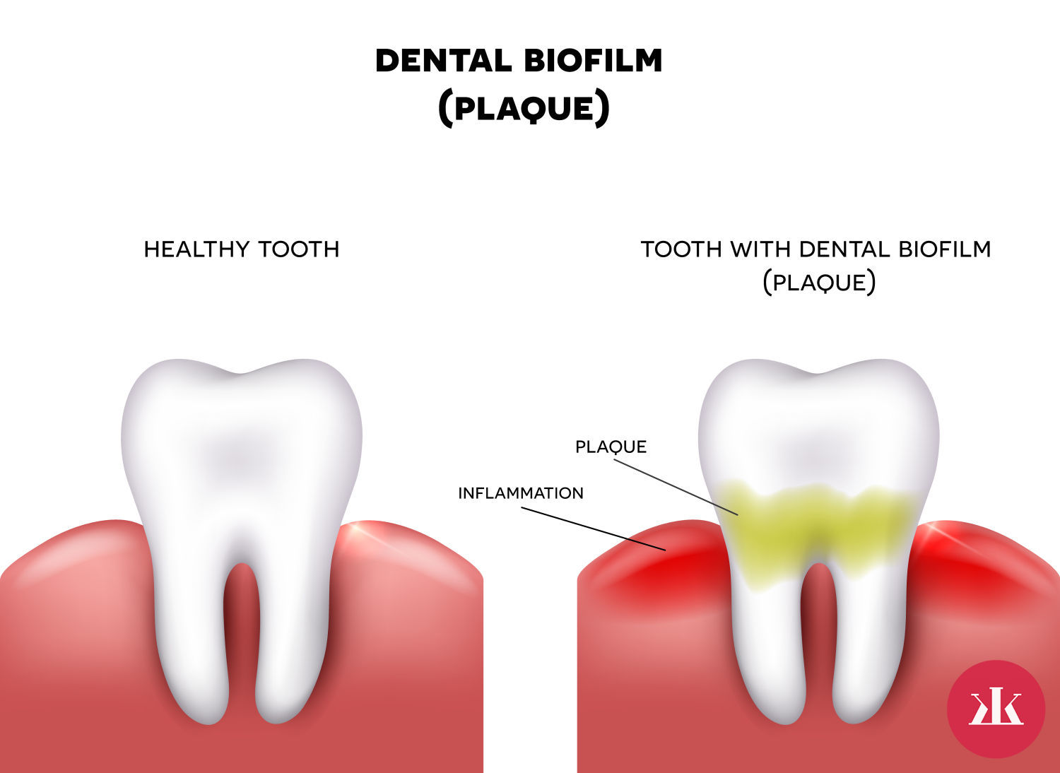 vznik a pricina zubneho plaku