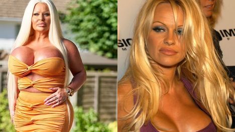 Minula tisíce libier, aby vyzerala ako Pamela Anderson. Muži ju milujú, ženy nenávidia