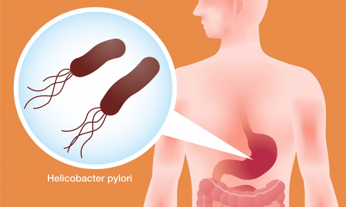 Helikobakter pylori: Spozoruj prvotné príznaky ochorenia čo najskôr!