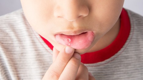 Bolestivé afty v ústach u detí: Čo pomáha pri aftóznej stomatitíde?