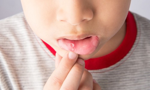 Bolestivé afty v ústach u detí: Čo pomáha pri aftóznej stomatitíde?