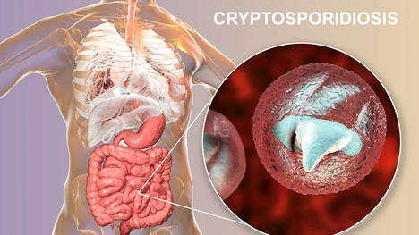 Nepríjemná parazitárna choroba: Aké ťažkosti spôsobuje kryptosporidióza?