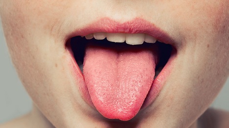 Malinový jazyk: Nedostatky akých vitamínov či ochorení signalizuje?