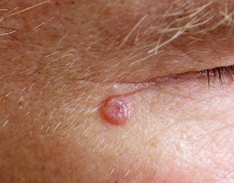 Bazalióm – najčastejší kožný nádor. Čo zvyšuje riziko jeho vzniku?