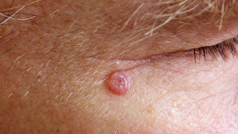 Bazalióm – najčastejší kožný nádor. Čo zvyšuje riziko jeho vzniku?