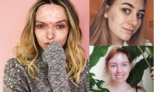 Nikto nie je dokonalý: Ženy odhaľujú svoje akné na Instagrame!