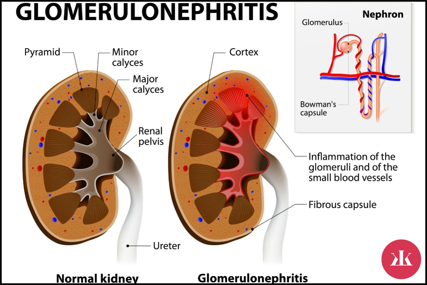 príznaky glomerulonefritídy