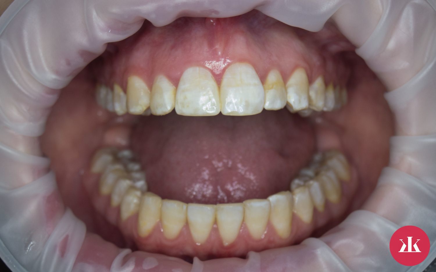 fluoridacia zubov