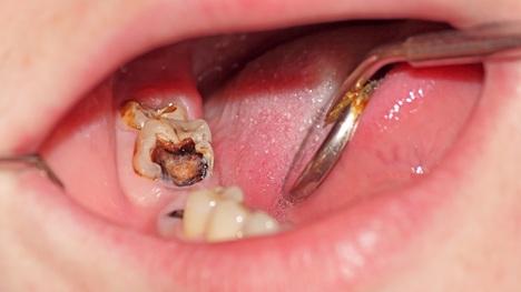Čo dokáže spôsobiť zubný kaz a zapálené ďasná? Tu je pravda o fatálnych následkoch
