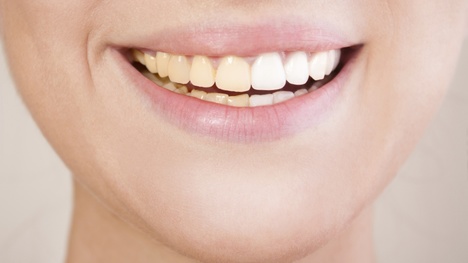 Ako predísť zafarbeniu zubov? Poradíme pri akom jedle by ste si mali dať pozor