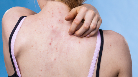 Ako vyliečiť bolestivé akné na chrbte? Stačí niekoľko malých zmien