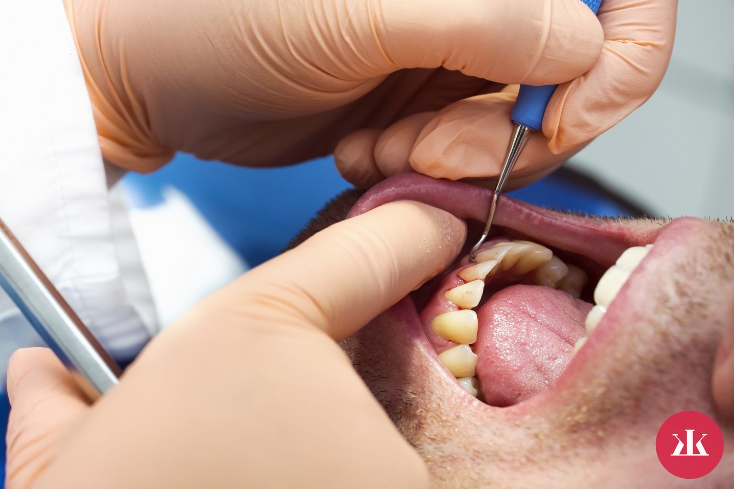 prejavy parodontitídy