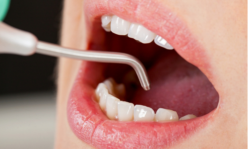Pieskovanie zubov: Získaj aj ty biele zuby bez námahy! Ako na to?