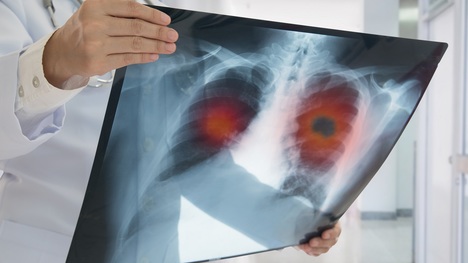 Rakovina pľúc prichádza nenápadne. Toto by sme o nej mali vedieť!