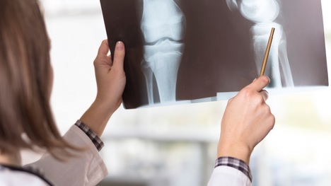 Najprv žiadny príznak, neskôr bolesť – to je zákerná rakovina kostí