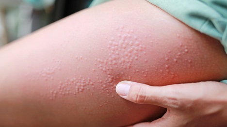 Ako sa prejavuje alergia na chlad? Človeka potrápi v zime i lete!