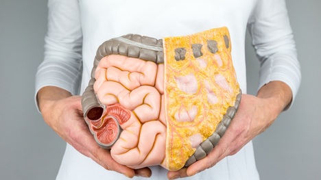 Prevencia rakoviny hrubého čreva: 5 krokov k zdravším črevám a telu