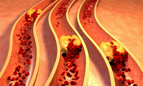 Ateroskleróza je postrachom pre naše cievy. Ako sa pred ňou chrániť?