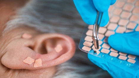 Nový druh akupunktúry: Ušné semiačka zmierňujú bolesť i nevoľnosť