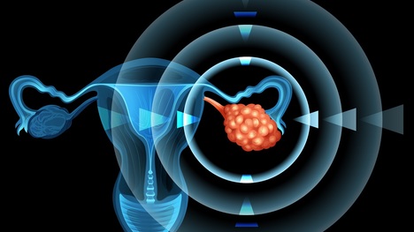 Zákerná rakovina vaječníkov: Dá sa rozpoznať včas? A čo liečba?