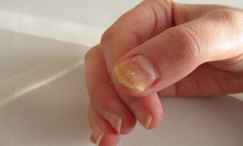 Žlté nechty na nohách i rukách signalizujú choroby nechtov: Kedy spozornieť?
