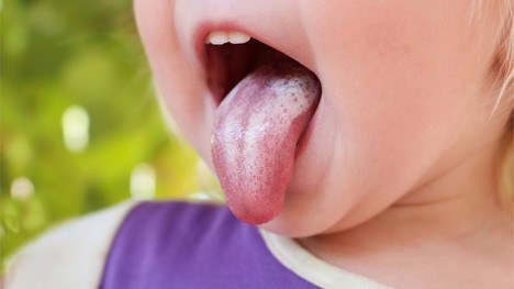 Nepríjemná infekcia v ústnej dutine: Ako sa prejavuje múčnivka?